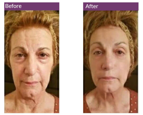 Wrinkle Reduction Serum